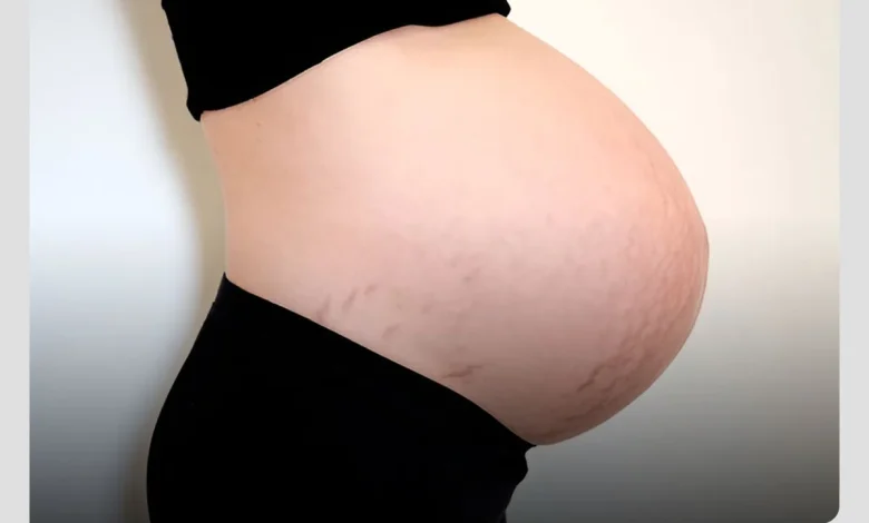 چنین دیررس و سن حاملگی مادر، یکی از عوامل موثر در پوست‌ریزی نوزاد