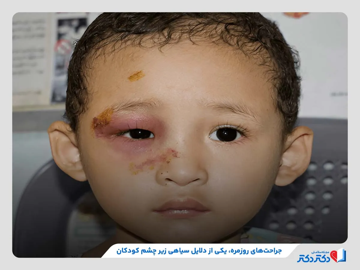 بررسی علل بروز سیاهی زیر چشم در کودکان