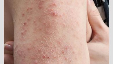 علائم تب دنگی