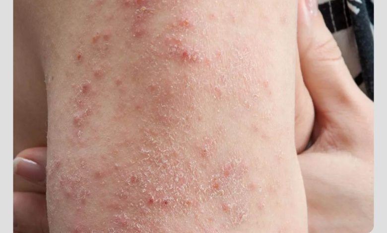 علائم تب دنگی