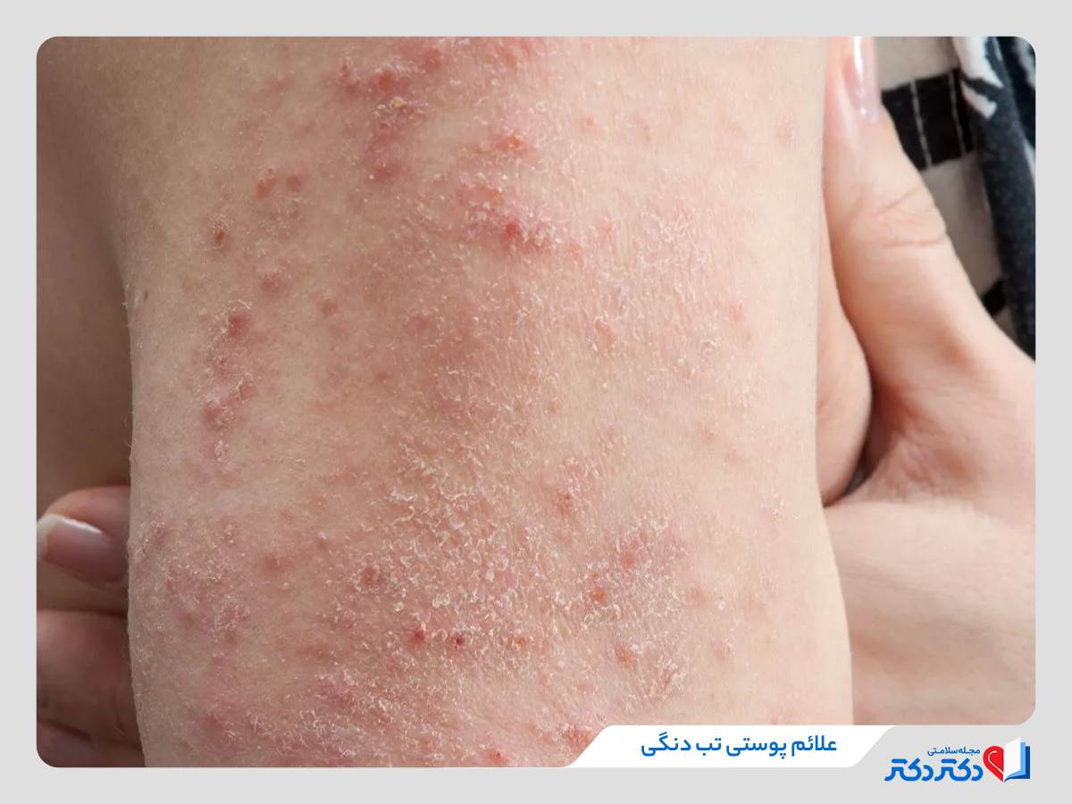 علائم تب دنگی