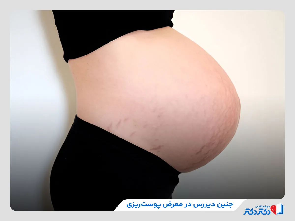 چنین دیررس و سن حاملگی مادر، یکی از عوامل موثر در پوست‌ریزی نوزاد