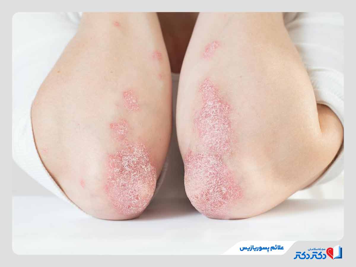 لکه‌های پوسته پوسته از علائم پسوریازیس