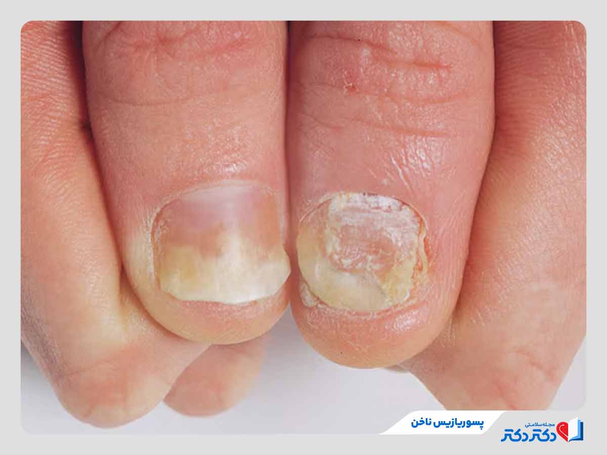 فرد مبتلا به پسوریازیس ناخون