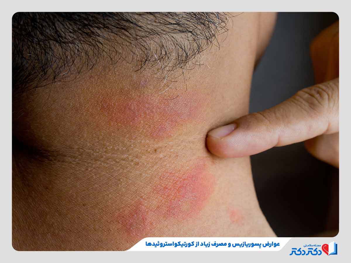 نازک شدن پوست گردن فرد به دلیل استفاده از داروهای پسوریازیس