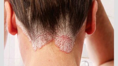 زن مبتلا به پسوریازیس به دلیل اختلالات ایمنی