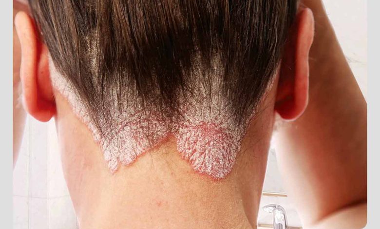 زن مبتلا به پسوریازیس به دلیل اختلالات ایمنی