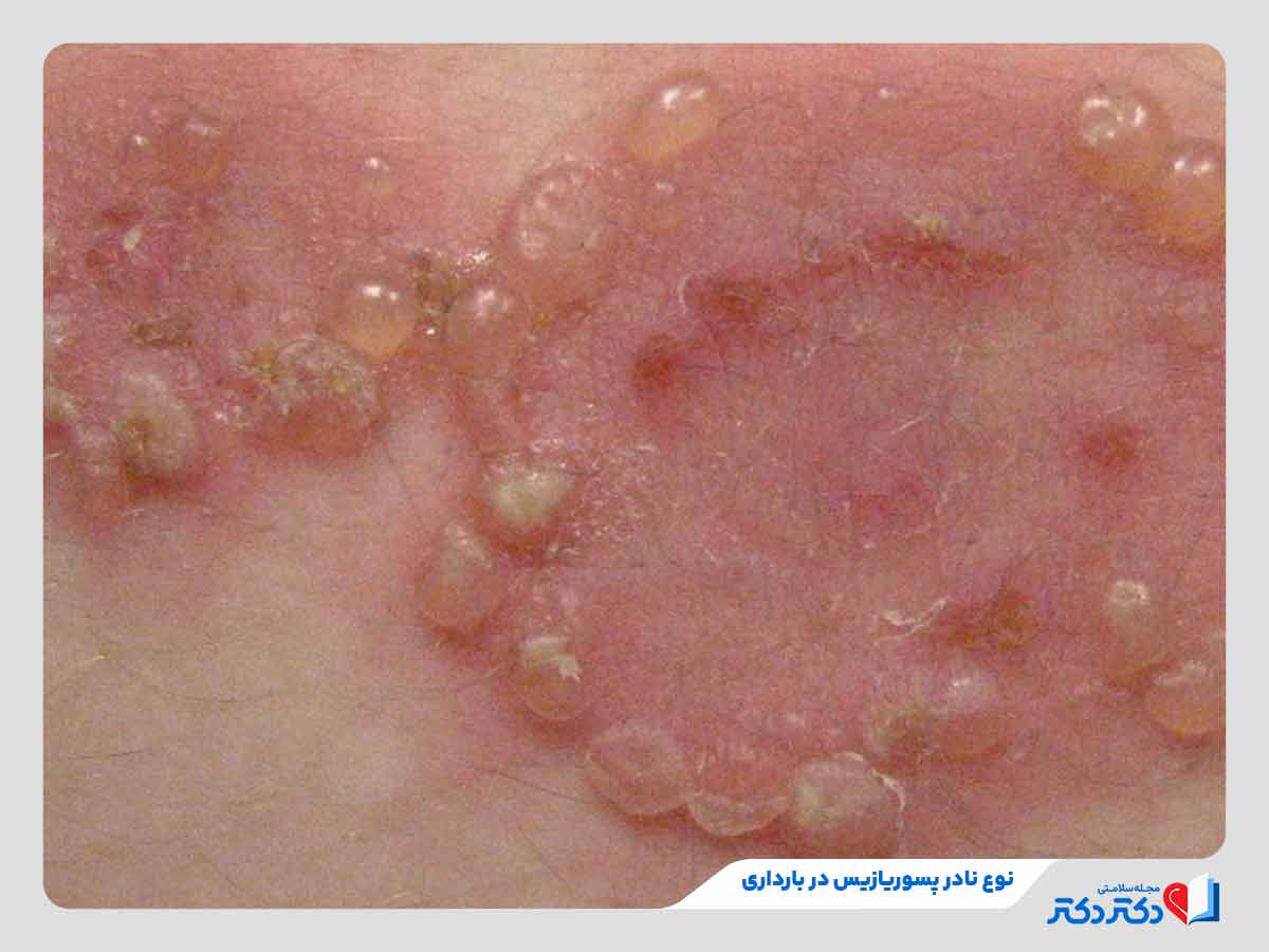 فرد مبتلا به نوعی هرپس بارداری از اختلالات پوستی در بارداری