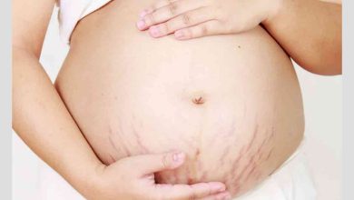 زن باردار مبتلا به ترک‌های پوستی از مشکلات پوستی دوران بارداری