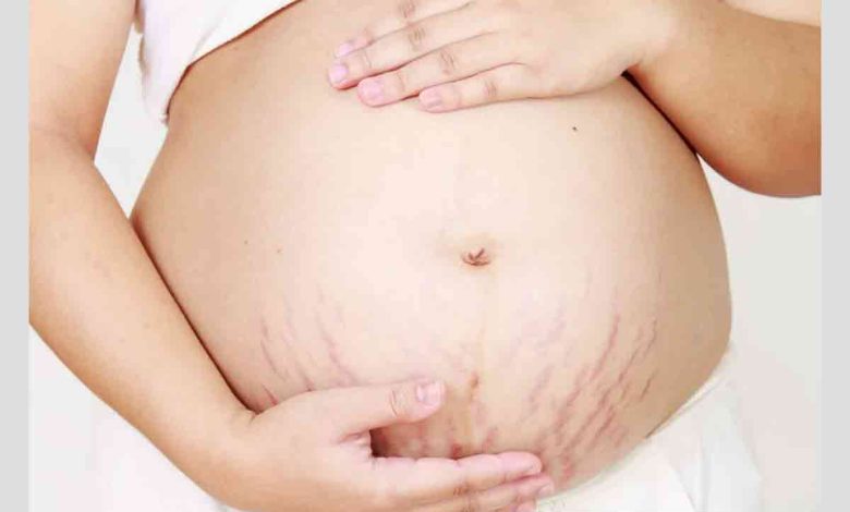 زن باردار مبتلا به ترک‌های پوستی از مشکلات پوستی دوران بارداری