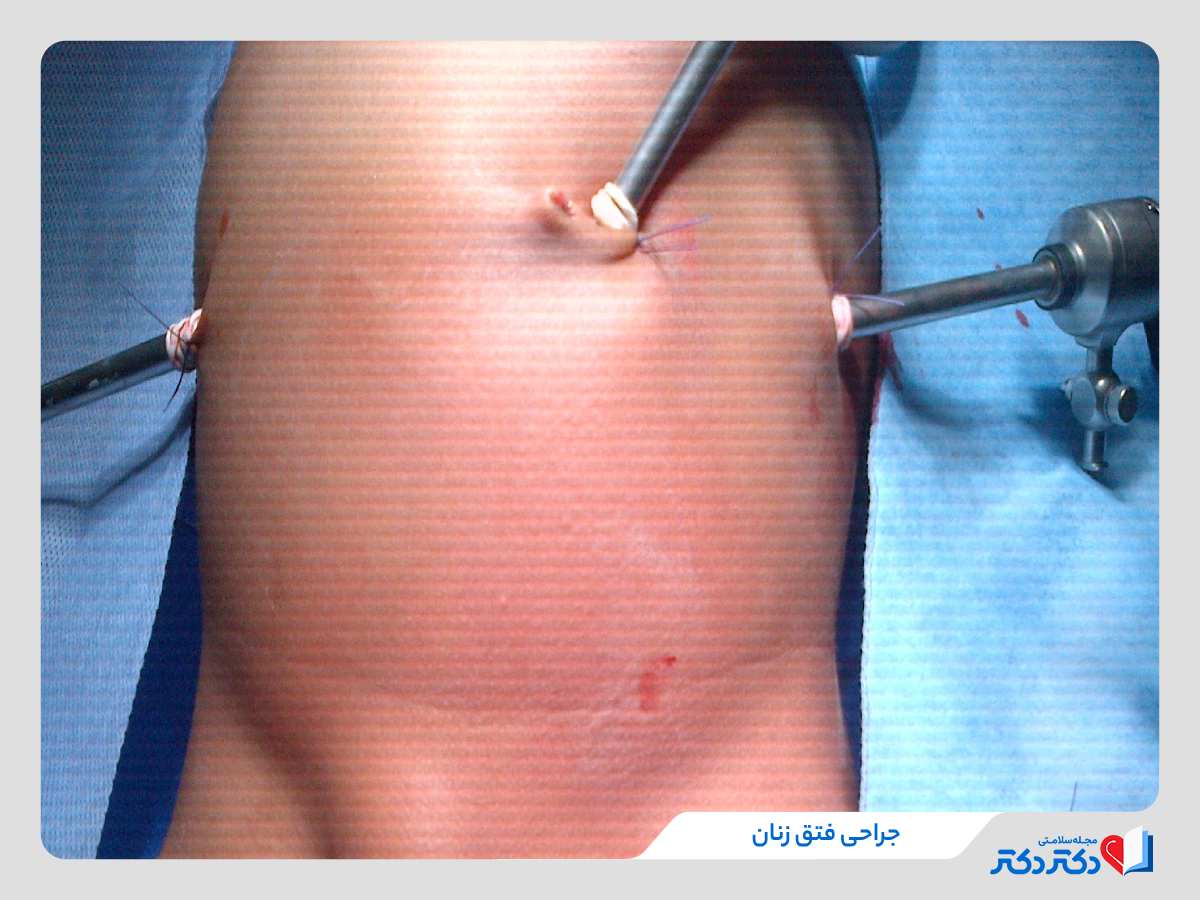 جراحی و درمان باد فتق زنان