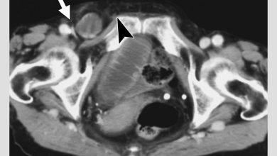 عکسبرداری از باد فتق زنان