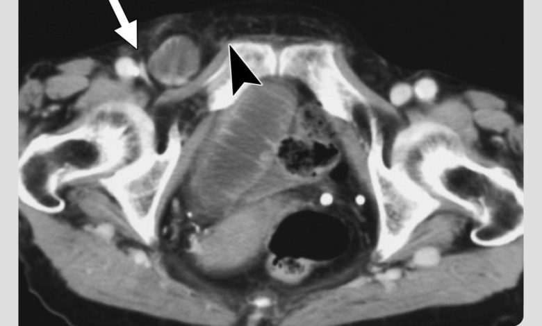عکسبرداری از باد فتق زنان