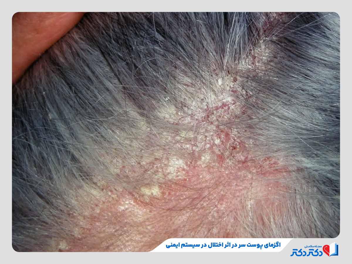 فرد مبتلا به درماتیت تماسی پوست سر در اثر اختلالات سیستم ایمنی