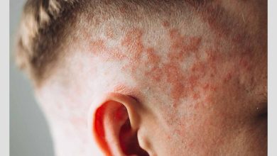 فرد مبتلا به التهاب و قرمزی پوست سر در اثر اگزمای پوست سر