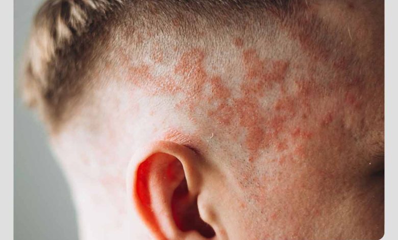فرد مبتلا به التهاب و قرمزی پوست سر در اثر اگزمای پوست سر